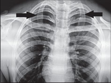 Chest X Ray Showing Bilateral First Rib Fracture With N Open I Sexiz Pix