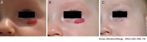 Propranolol In The Treatment Of Infantile Hemangioma Clinical Effectiveness Risks And
