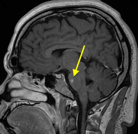 Some of these conditions include adrenocortical insufficiency, high blood calcium, rheumatoid arthritis, dermatitis, eye inflammation, asthma, and multiple sclerosis. Bell Palsy Treatment Prednisolone Dose / Corticosteroids ...