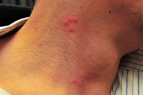 How To Identify Bed Bug Bites—and How To Treat Them