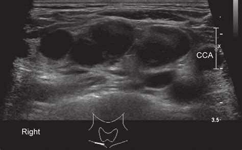 Ultrasound Of Patients Neck Region Revealing Multiple Enlarged Lymph Download Scientific