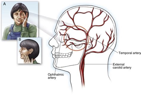 Headache Associated With Temporal Arteritis Anesthesia Key