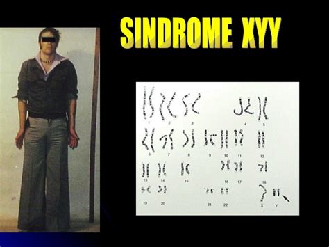 Super Hombre O Sindrome Xyy On Emaze