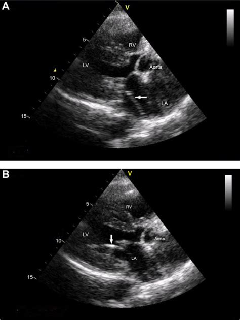 A And B Two Dimensional Transthoracic Echocardiography With A