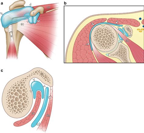 Shoulder bursitis is often accompanied by tendinitis of tendons adjacent to the affected bursa in the shoulder. Shoulder Bursae Anatomy - Anatomy Drawing Diagram