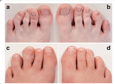 Toe Deformities Of Two Patients With Moebius Clinical Photographs Of