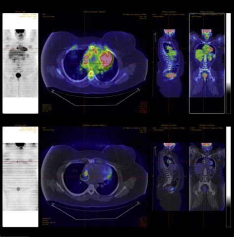 E 18f Fdg Petct Demonstrating Intense Metabolic Activity With The