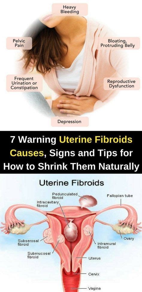 Here Are 7 Warning Uterine Fibroids Causes Signs Tips For How To