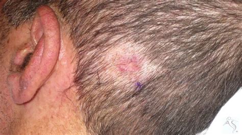 Basal Cell Carcinoma Of The Scalp Youtube