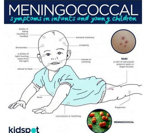 Meningococcal Symptoms Mother Of Patient Says She Didnt Know What To