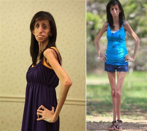 Skinniest Person In The World Lizzie Velasquez Skinny People