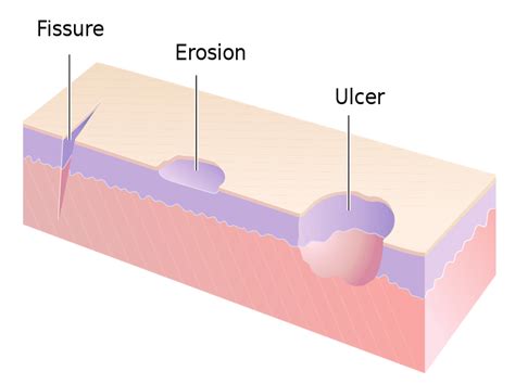Term Used To Describe Skin Ulceration Caused By Prolonged Pressure