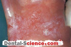 Biopsy showed mild epithelial leukoplakia located on the floor of the mouth, the posterior and lateral tongue, and the retromolar. Keratoses: Clinical features, Incidence, Etiology ...