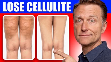 Get Rid Of Cellulite For Good Dr Berg S Better Way To Lose Flabby Fat