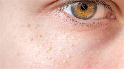 What Is Milia What Causes It And How To Get Rid Of The Spots Mamabella