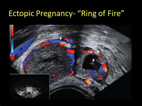 Ring Of Fire Appearance In Ectopic Pregnancy