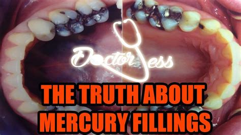 This high mercury content is incredibly dangerous because mercury is a toxic element. Secrets of Mercury Fillings and Biological Dentistry ...