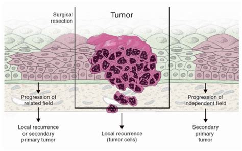 Squamous Cell Carcinoma Diagram
