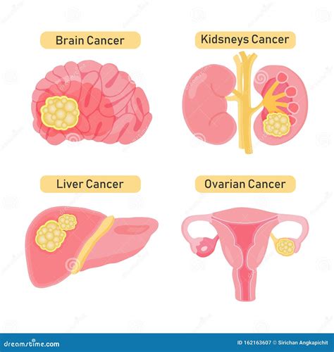 types of ovarian cysts set infographics vector illustration on isolated background