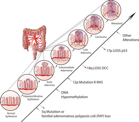 A Genetic Model For Colorectal Tumorigenesis Adapted From Fearon And Download Scientific