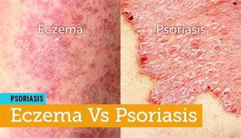 How To Tell Whether That Itchy Rash Is Eczema Or Psoriasis Hk