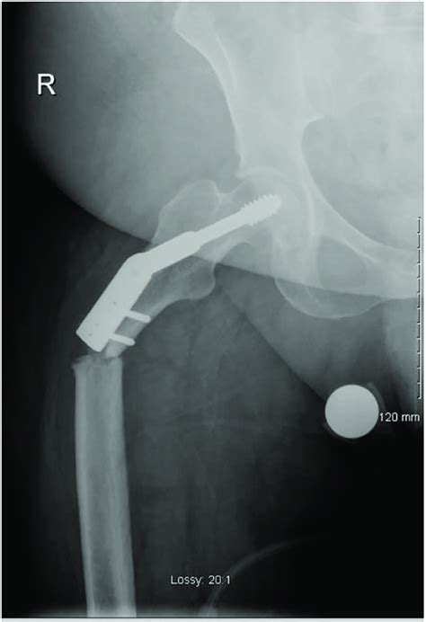 Anteroposterior X Ray Of Right Hip With Periprosthetic Subtrochanteric