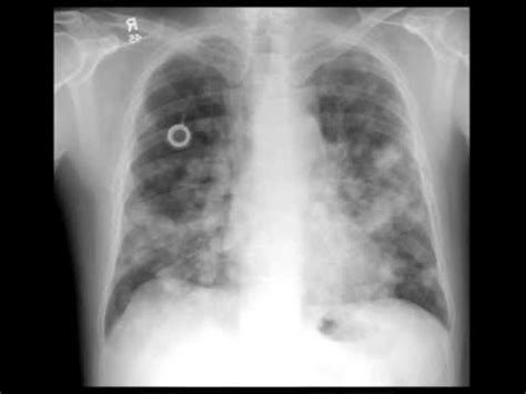 Lung Metastases On Chest X Ray Youtube