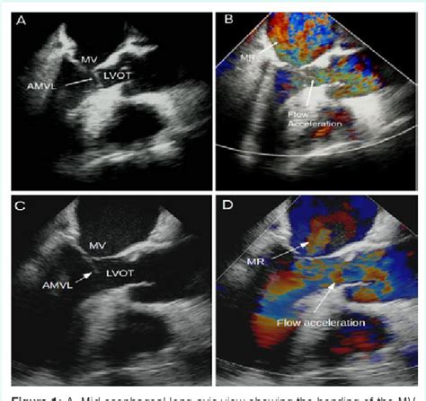 Figure 1 From Dynamic Left Ventricular Outflow Tract Obstruction During