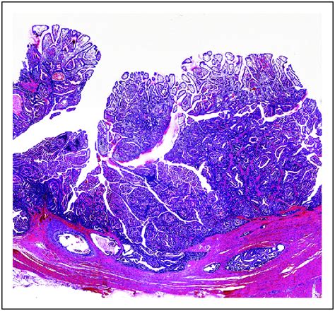 Histological Features Of Peutz Jeghers Polyp Characteristic Is
