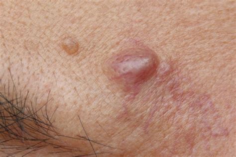 Cyst Lipoma Removal Medical And Surgical Dermatology The Skin Care