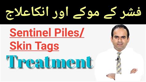 Sentinel Piles Sentinel Skin Tags Of Anal Fissure And Its Treatment Surgeon Dr Imtiaz Hussain
