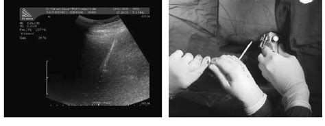 Figure 1 From Ultrasonography Guided Punctures With And Without