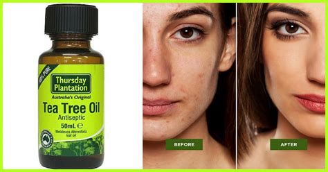 Tea Tree Oil For Acne Benefits Uses Risks And More