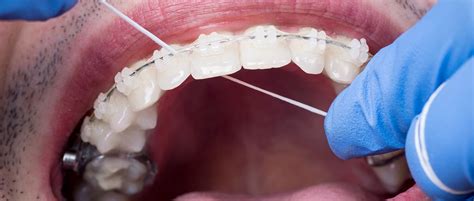 6 Tips For Caring For Ceramic Braces In Albany Estes Orthodontics