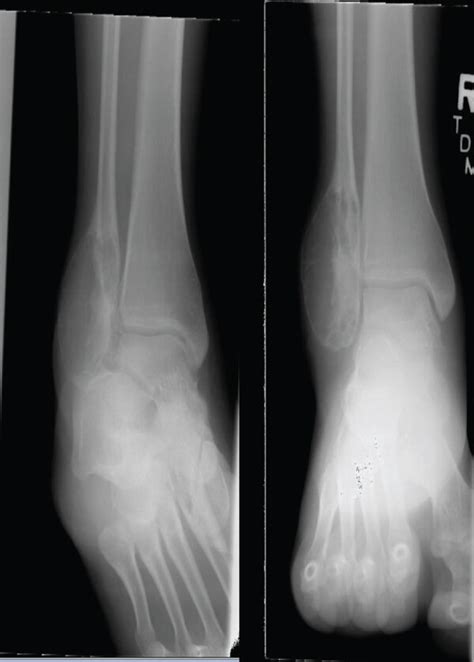 Ap And Mortise Radiographs Of The Ankle Demonstrating A Lytic