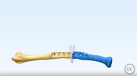 3d Printed Saw Guides And Provisional Plate For Corrective Osteotomy Of