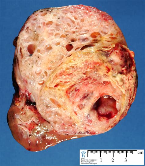 cystic Wilms tumor - Humpath.com - Human pathology