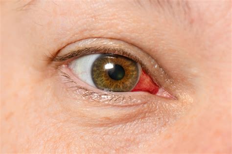 Signs Of Corneal Injury Magruder Eye Institute