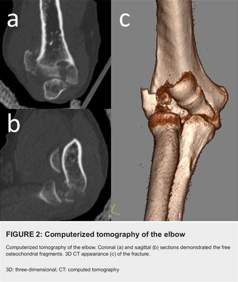 Figure 2 From Fixation Of Small Osteochondral Fragments In A Comminuted