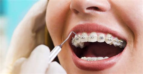 Bond Strength Of Adhesive Systems For Orthodontic Brackets Dental News