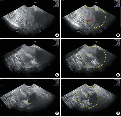 Transvaginal Ultrasound Guided Myometrial Injection Of Radiotracer In