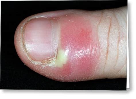 Paronychia is a soft tissue infection around a fingernail. Paronychia Infection Of The Thumb Photograph by Dr P ...