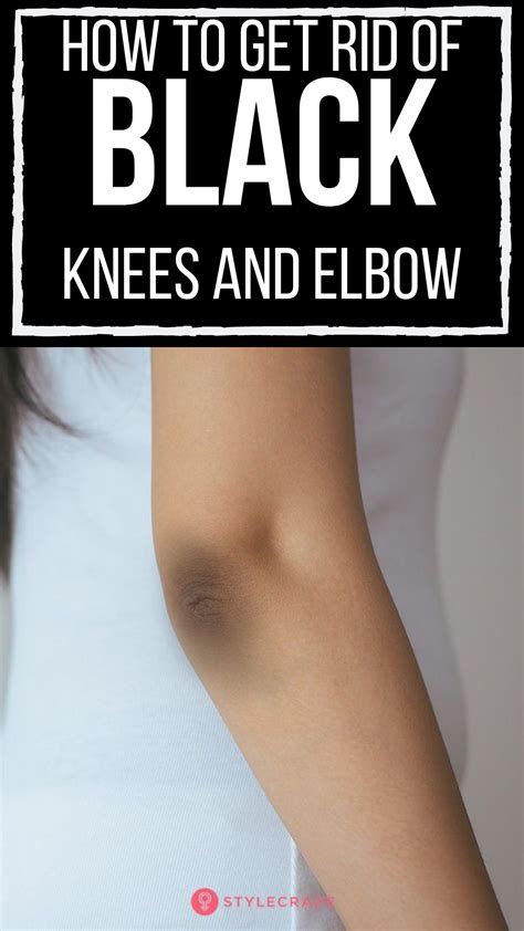 14 Home Remedies To Get Rid Of Dark Knees And Elbows Artofit