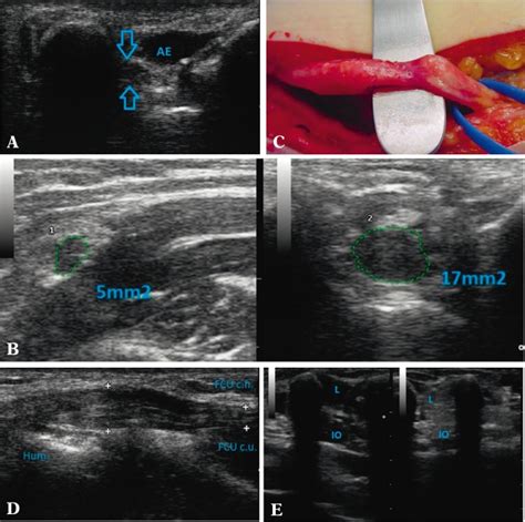 Ultrasound Assessment On Selected Peripheral Nerve Pathologies Part I