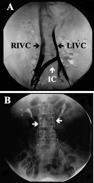 Congenital Double Inferior Vena Cava And Dual Filter Placement A