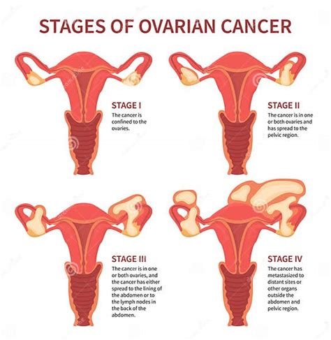 Four Stages Of Womans Ovarian Cancer Isolated Stock Vector