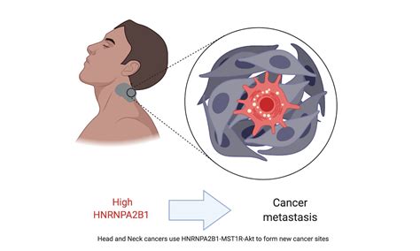 Head And Neck Cancer Metastasizes Using A New Epigenetic Trick