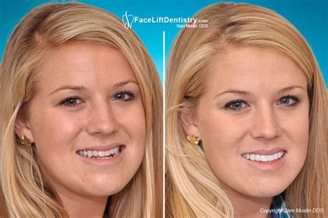 A deep overbite is one of the longest orthodontic conditions to fix with braces. Underbite Correction with VENLAY Restorations