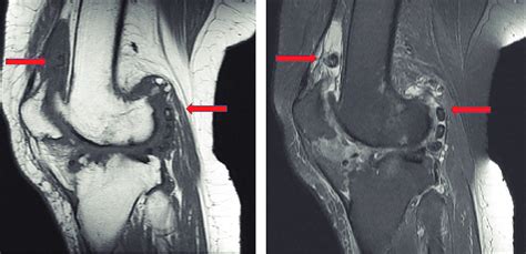 Left Knee Magnetic Resonance Imaging Mri Showing Multiple Hypointense