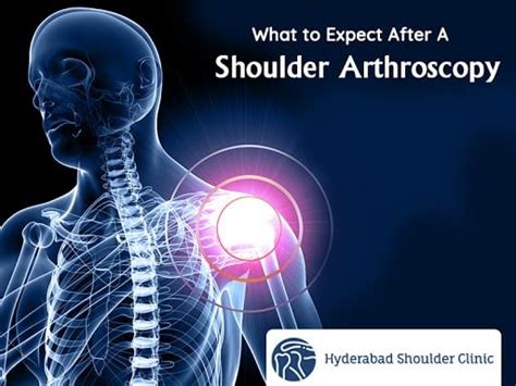 Recovery From Rotator Cuff Surgery Shoulder Clinic Hyderabad